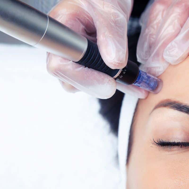 Morpheus8 treatment West Thurrock from Lipo Sculpt - Book in today!