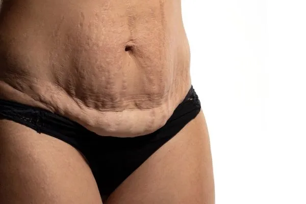 Lost the Weight but Not the Loose Skin? 1 image of womans stomach after weight loss showing loose skin West Thurrock